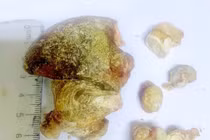 Lấy sỏi san hô 7 cm, bảo tồn thận cho người bệnh 70 tuổi