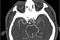 Giải pháp điều trị hiệu quả đột quỵ khi thức giấc vào buổi sáng