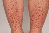 Cẩn thận trẻ phát ban do viêm mạch IgA gây hỏng thận