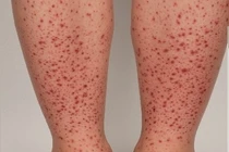 Cẩn thận trẻ phát ban do viêm mạch IgA gây hỏng thận