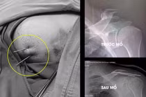 Phẫu thuật gãy xương trên màn hình C.Arm, đơn giản hóa những ca bệnh phức tạp