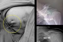 Phẫu thuật gãy xương trên màn hình C.Arm, đơn giản hóa những ca bệnh phức tạp