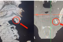 Sưng đau vùng hàm không ngờ sỏi tuyến nước bọt