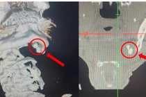 Sưng đau vùng hàm không ngờ sỏi tuyến nước bọt