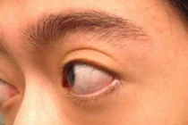 Trợn mắt, lồi mắt do cố ý hay bệnh tuyến giáp?