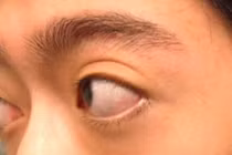 Trợn mắt, lồi mắt do cố ý hay bệnh tuyến giáp?