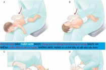 Bác sĩ hướng dẫn cách thực hiện thủ thuật Heimlich đúng tránh biến chứng