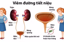 Nhiễm trùng tiết niệu tiền mãn kinh, hiểu để bảo vệ sức khỏe từ gốc
