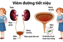 Nhiễm trùng tiết niệu tiền mãn kinh, hiểu để bảo vệ sức khỏe từ gốc