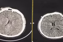 Hạ thân nhiệt chỉ huy cứu sống thanh niên phù não sau thắt cổ tự tử
