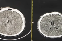 Hạ thân nhiệt chỉ huy cứu sống thanh niên phù não sau thắt cổ tự tử