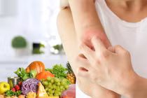 Những lưu ý dinh dưỡng giúp bệnh nhân vảy nến kiểm soát bệnh