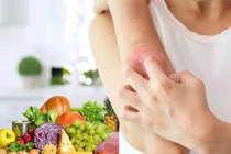 Những lưu ý dinh dưỡng giúp bệnh nhân vảy nến kiểm soát bệnh