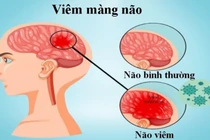 Các loại viêm màng não thường gặp
