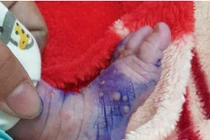 30% trẻ sơ sinh mắc thủy đậu tử vong, cách gì phòng tránh?