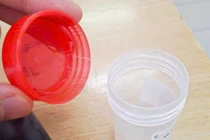 Gắp ký sinh trùng dài gần 10 cm trong mắt người phụ nữ