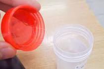 Gắp ký sinh trùng dài gần 10 cm trong mắt người phụ nữ