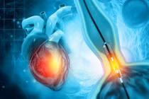 Chụp mạch vành qua đường ống thông có gây nguy hiểm?