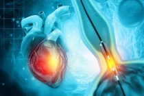 Chụp mạch vành qua đường ống thông có gây nguy hiểm?