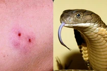 Bị rắn cắn nên, không nên làm gì?