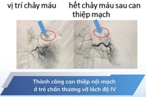 Can thiệp nội mạch cứu trẻ 5 tuổi vỡ lách độ IV