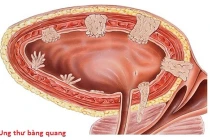 Bác sĩ chỉ rõ các yếu tố nguy cơ ung thư bàng quang