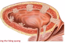 Bác sĩ chỉ rõ các yếu tố nguy cơ ung thư bàng quang