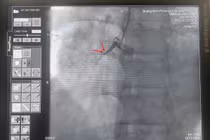 Can thiệp giành lại sự sống cho bệnh nhân ngừng tim vô cùng nguy kịch