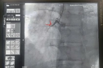 Can thiệp giành lại sự sống cho bệnh nhân ngừng tim vô cùng nguy kịch