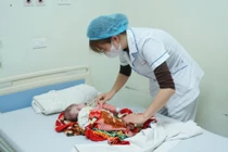 Phẫu thuật thành công cho trẻ 3 ngày tuổi bị thoát vị tủy – màng tủy