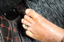 Can thiệp nội mạch “cứu” chân hoại tử cho người tắc động mạch chi dưới