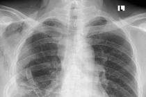 Cắt u trung thất khổng lồ nặng 3,6 kg hiếm gặp trong y văn