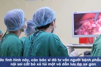 Sỏi túi mật, áp xe gan do ký sinh trùng: Cẩn thận thực phẩm "khoái khẩu"