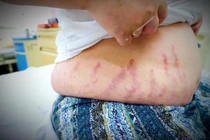 Từ con dị ứng mũi tự điều trị thành suy tuyến thượng thận