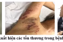 Điều trị chứng đau sau mắc zona thần kinh bằng vật lý trị liệu