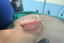 Cứu thành công nam học sinh bị chìa khóa cắm sâu vào đầu