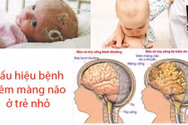 Viêm màng não dễ nhầm với cảm lạnh