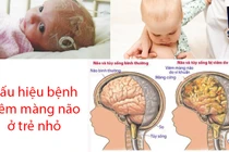 Viêm màng não dễ nhầm với cảm lạnh