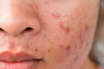 Làm sao chữa dứt điểm mụn trứng cá?