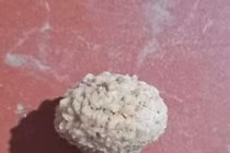 Sỏi bàng quang vì thường xuyên nhịn tiểu