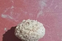 Sỏi bàng quang vì thường xuyên nhịn tiểu