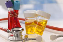 Xử lý khi có máu trong nước tiểu