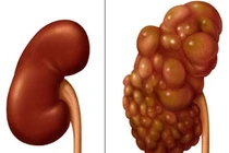 Thận đa nang mang tính di truyền 