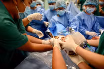 Khoảnh khắc tách rời hai bé song sinh dính liền