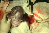 Cách phát hiện khối u buồng trứng