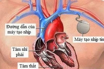 Lưu ý trong sinh hoạt sau cấy máy tạo nhịp