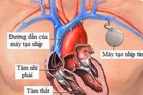 Lưu ý trong sinh hoạt sau cấy máy tạo nhịp