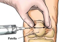 Tiêm Acid hyaluronic chữa thoái hóa khớp