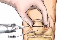 Tiêm Acid hyaluronic chữa thoái hóa khớp