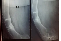 Phẫu thuật thành công ca gãy xương thủy tinh nặng 